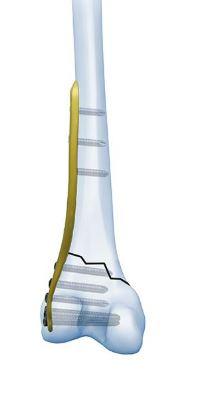 Дистально-латеральна стегнова пластина, ліва, ( Double Medical Technology Inc.)